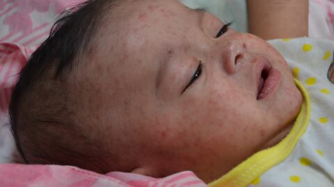 A child showing the characteristic measles rash